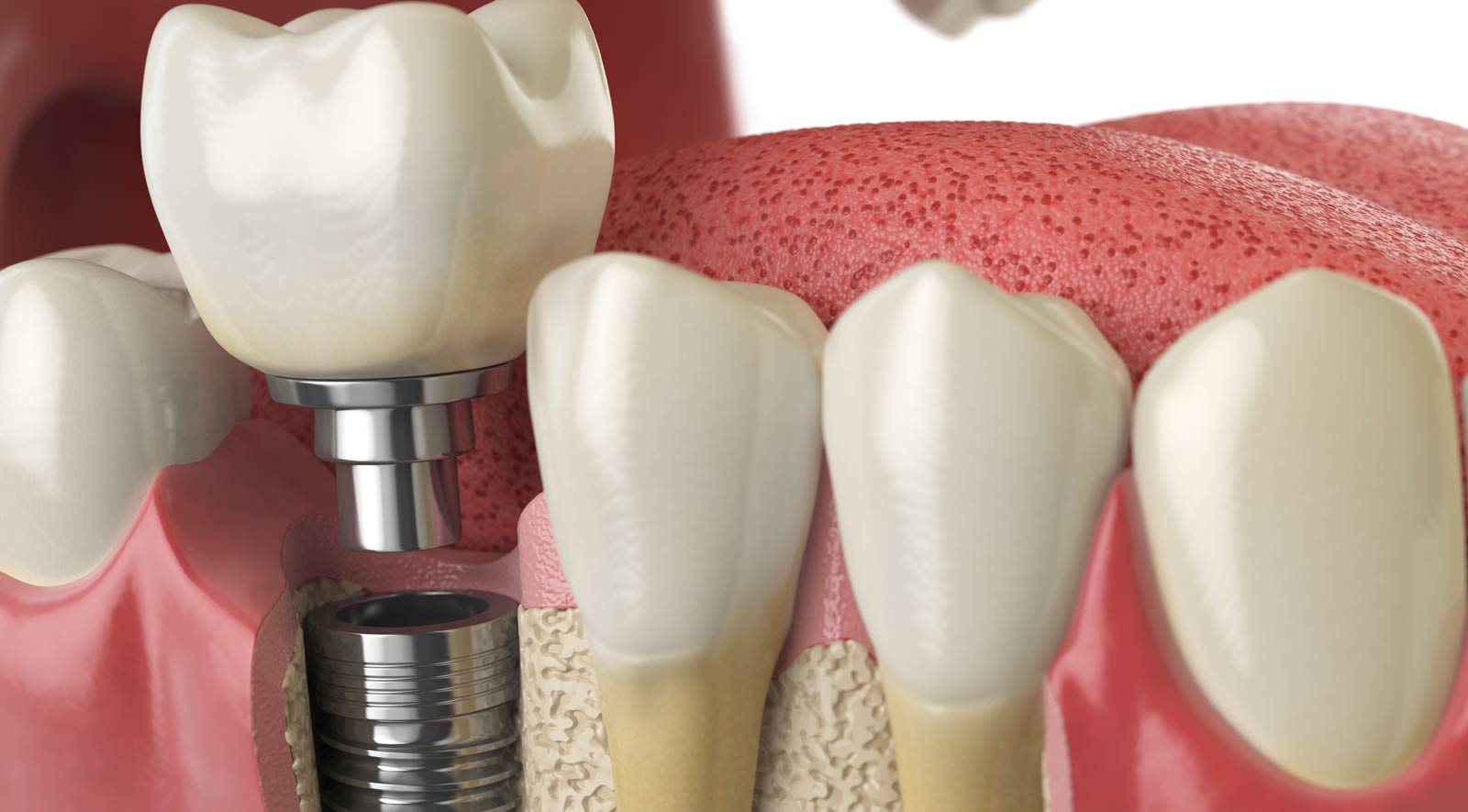 Dental Implant image