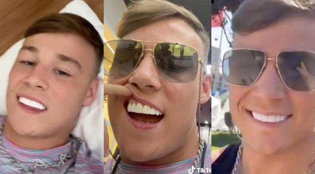 Young man showing his badly made "Turkey Teeth"