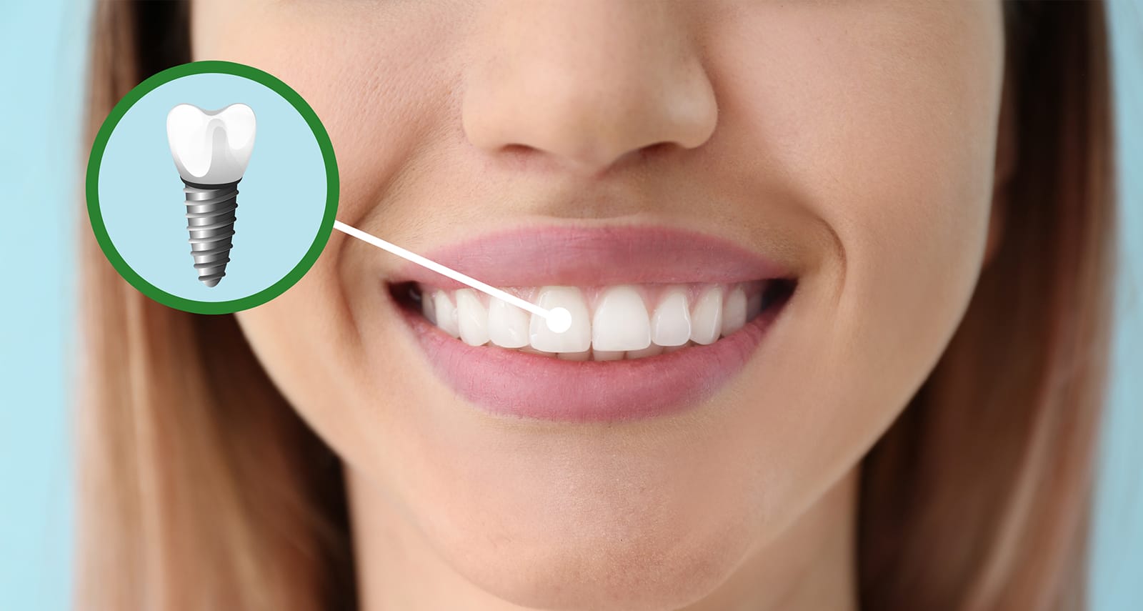 Dental Implants In Turkey