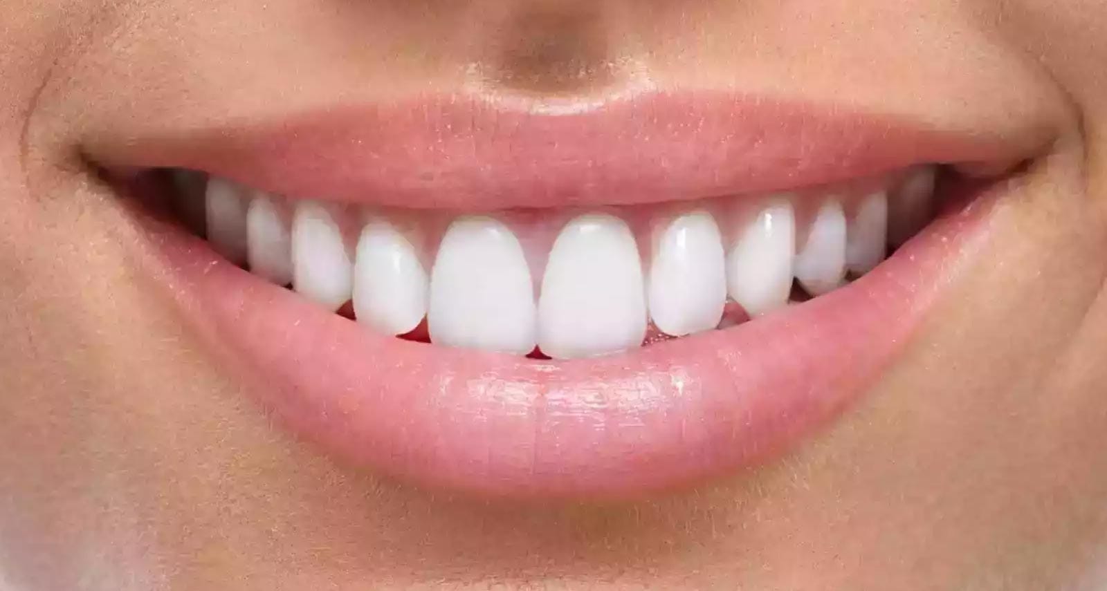 Veneers In Turkey