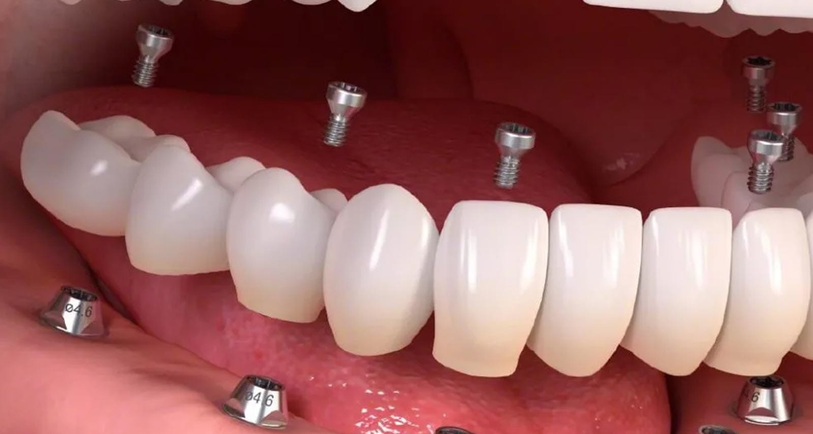 All On - Persona Smile Dental Clinic Antalya