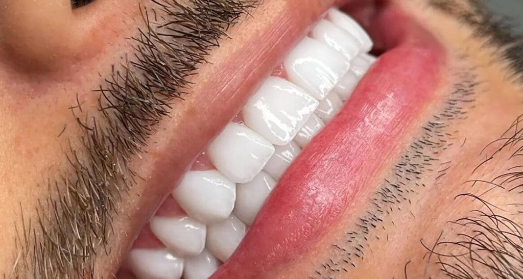 Cost Of Dental Implants In Turkey