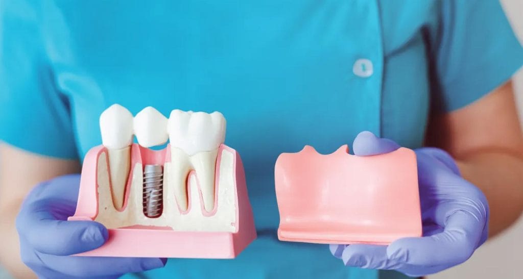 Dental Implants In Turkey What You Must Know