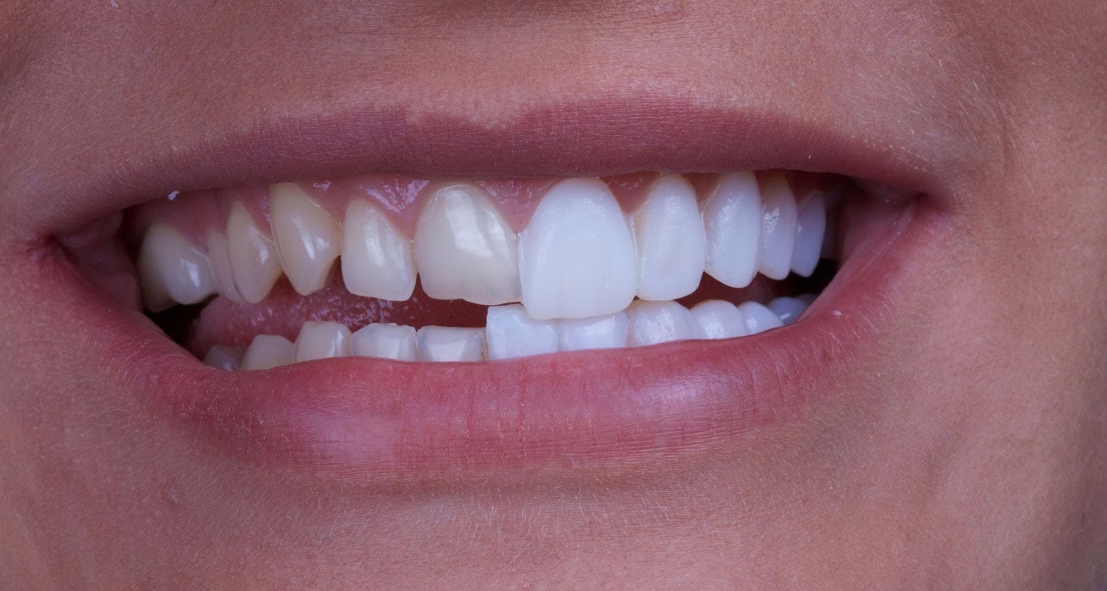 Veneers
