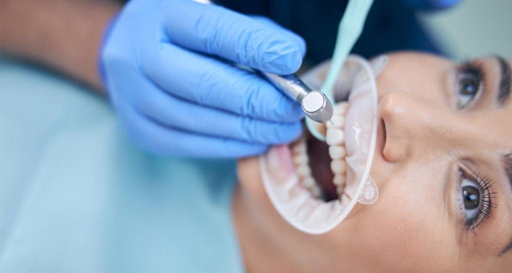 Dental Bonding