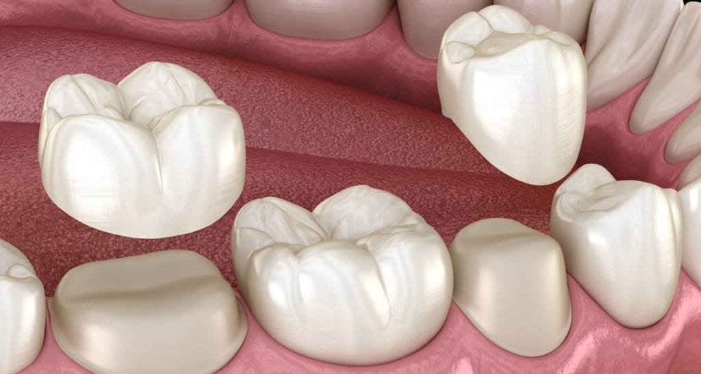 Dental Crowns Turkey