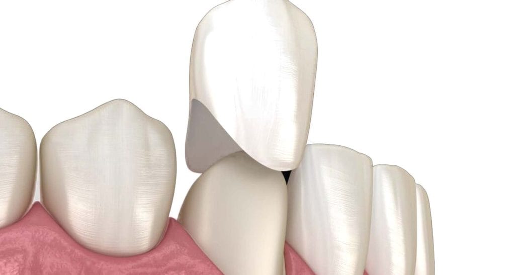 Dental Crowns