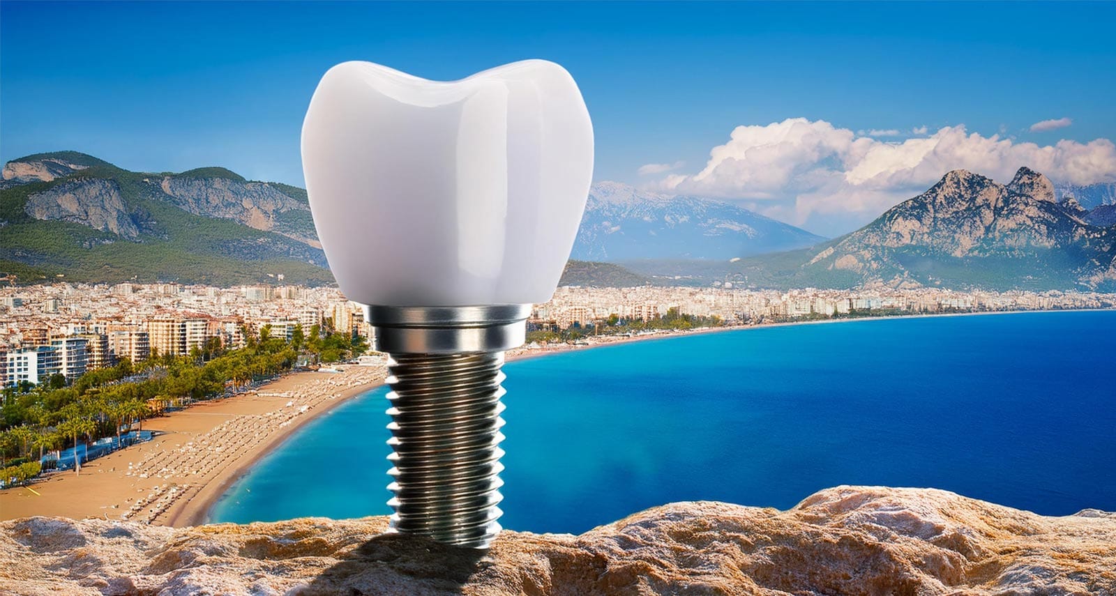 Dental Implants In Antalya