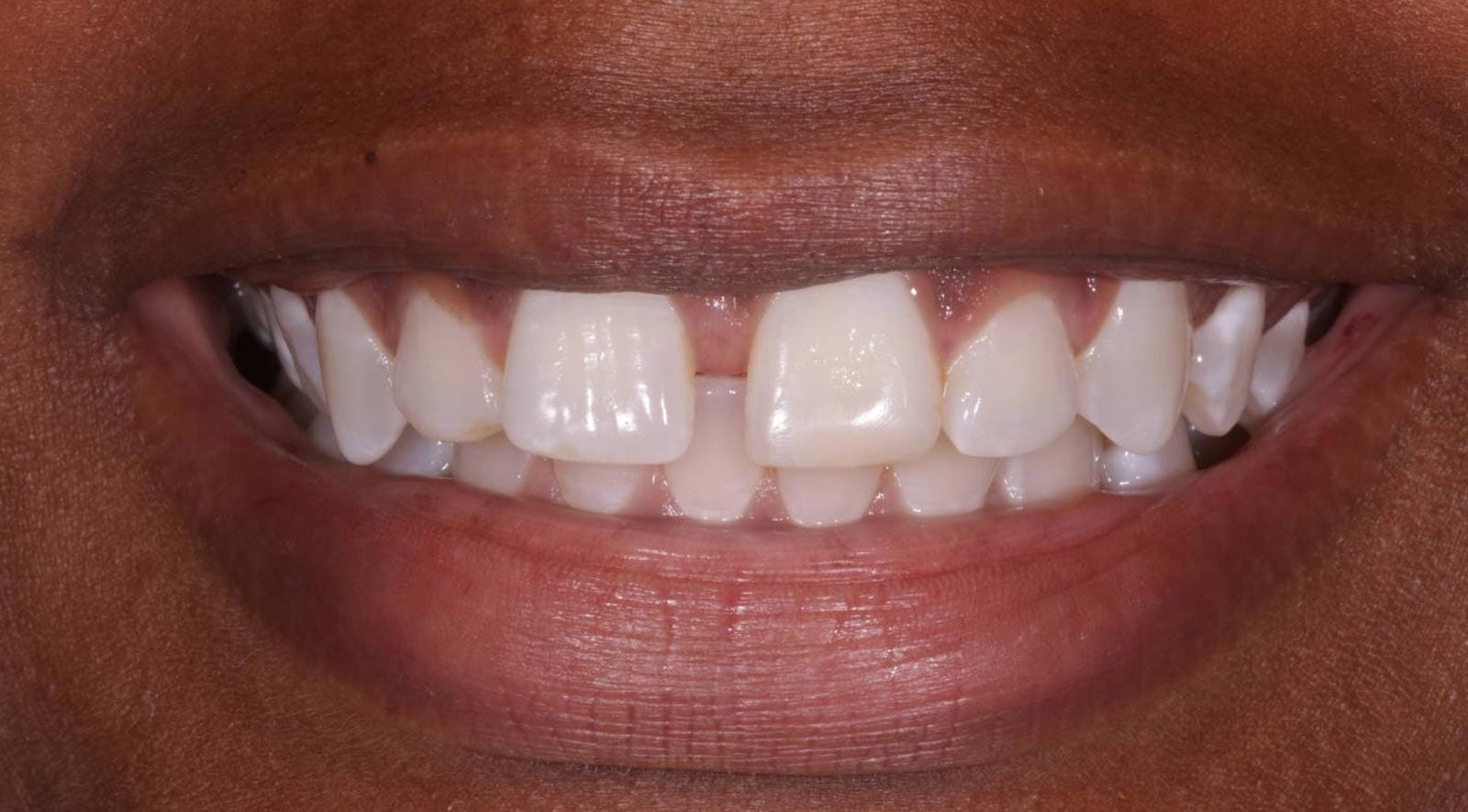 Buck Teeth