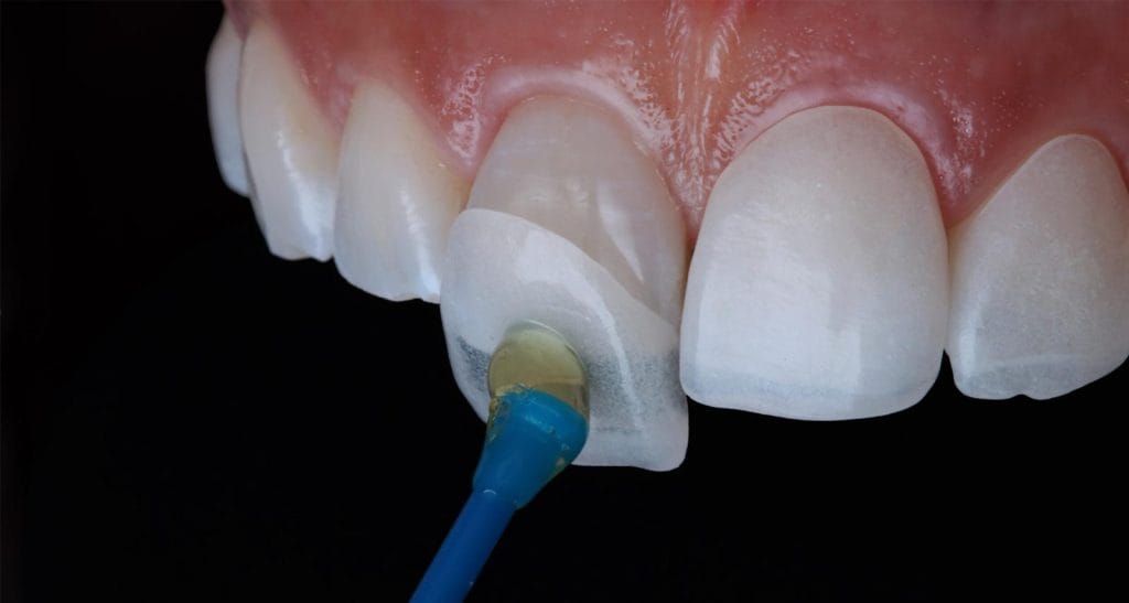 Veneers